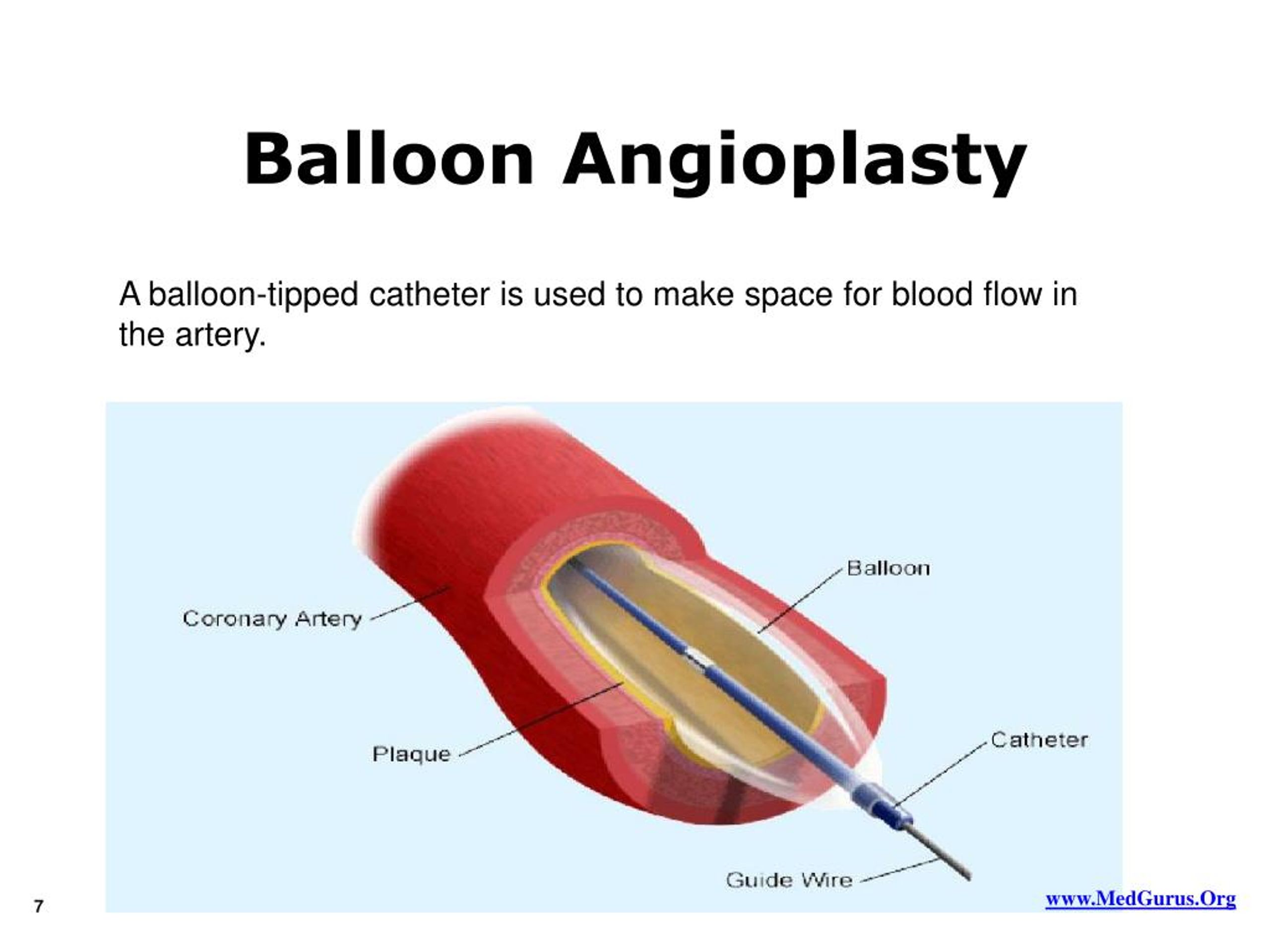 PPT Facts on Angioplasty PowerPoint Presentation, free download ID