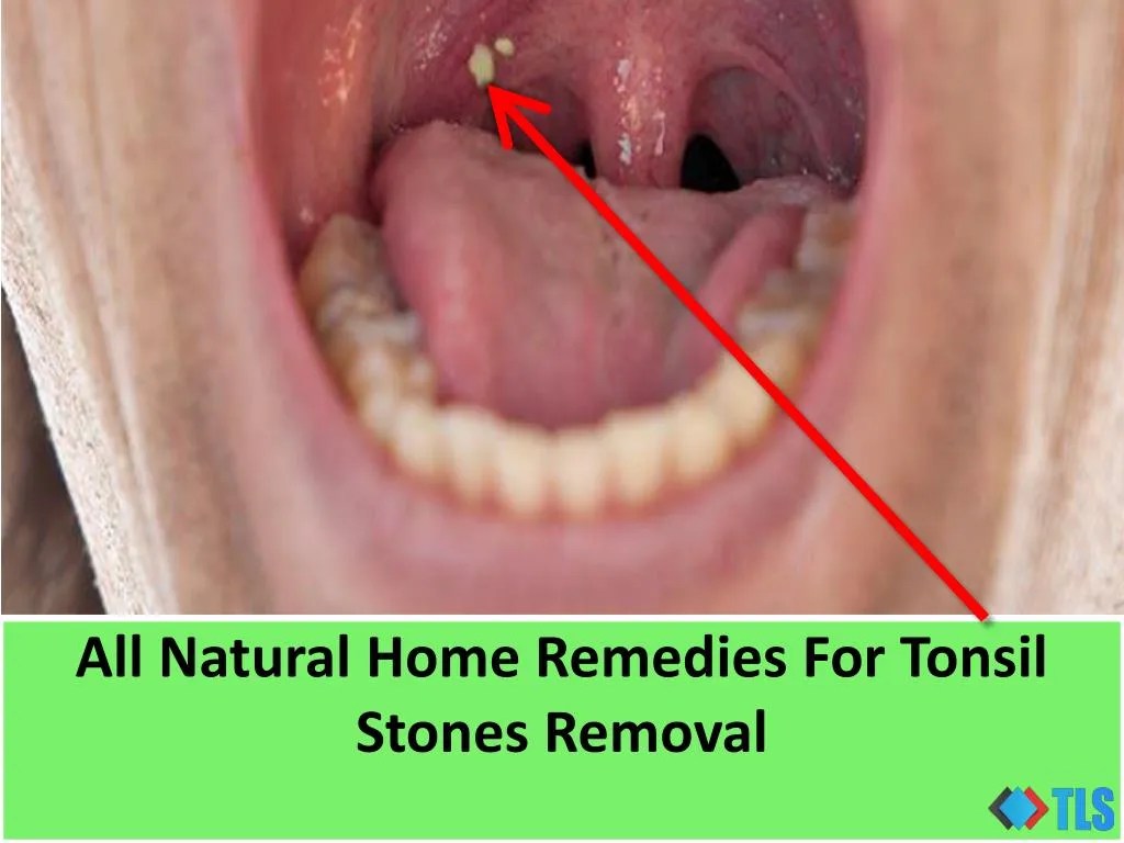 PPT All Natural Home Remedies For Tonsil Stones Removal PowerPoint