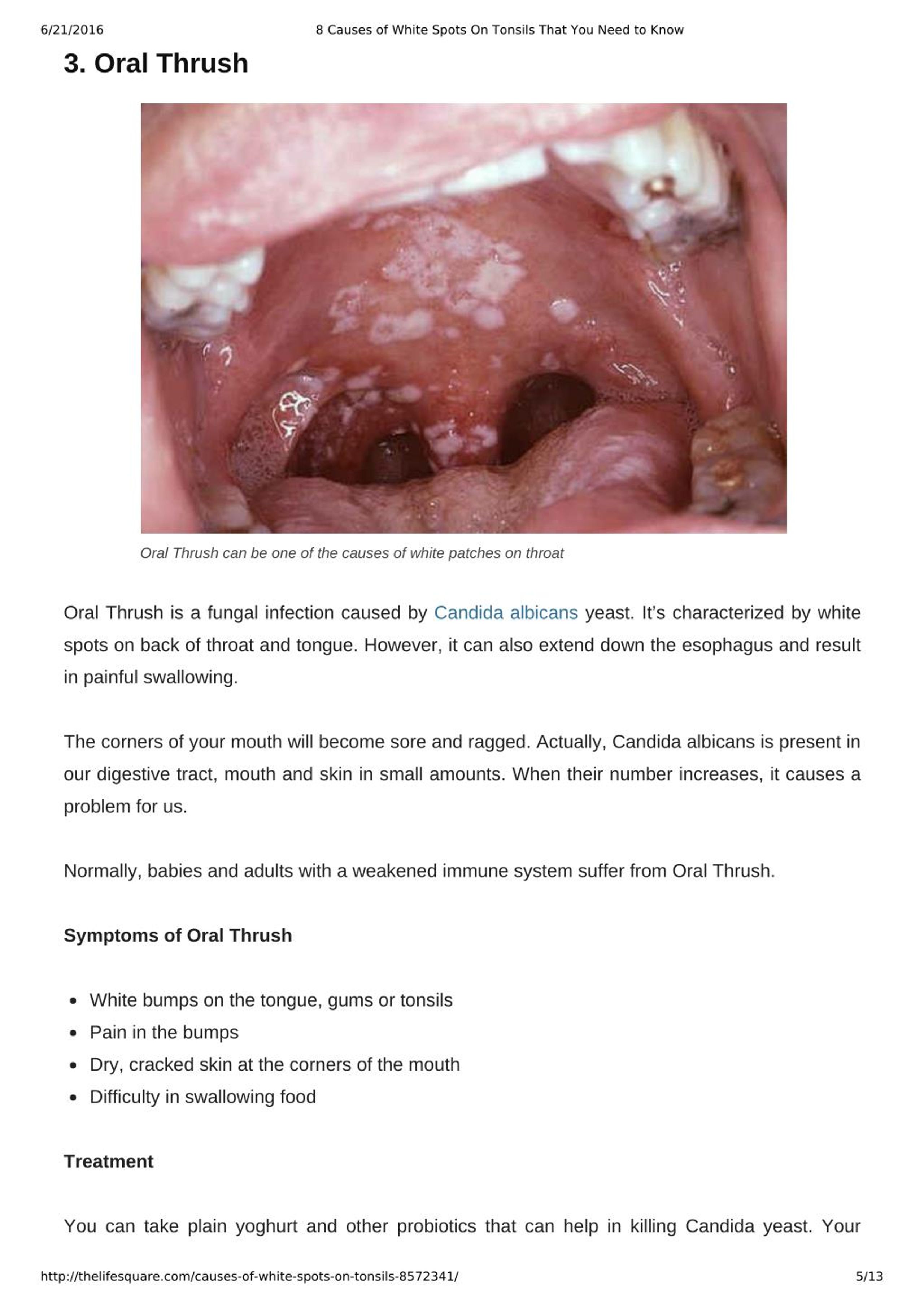 PPT 8 Causes of White Spots On Tonsils You May Not Know