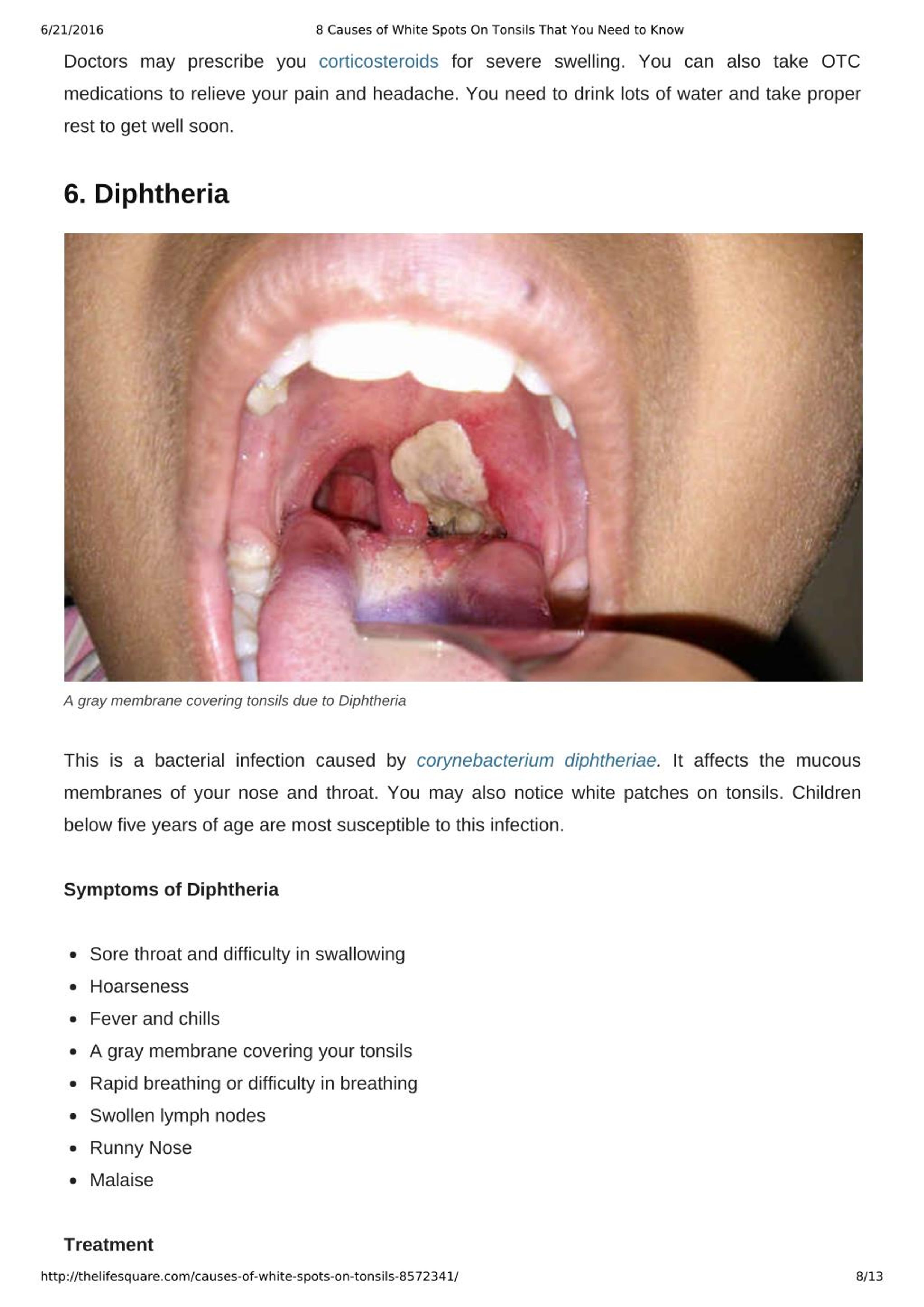 PPT 8 Causes of White Spots On Tonsils You May Not Know PowerPoint