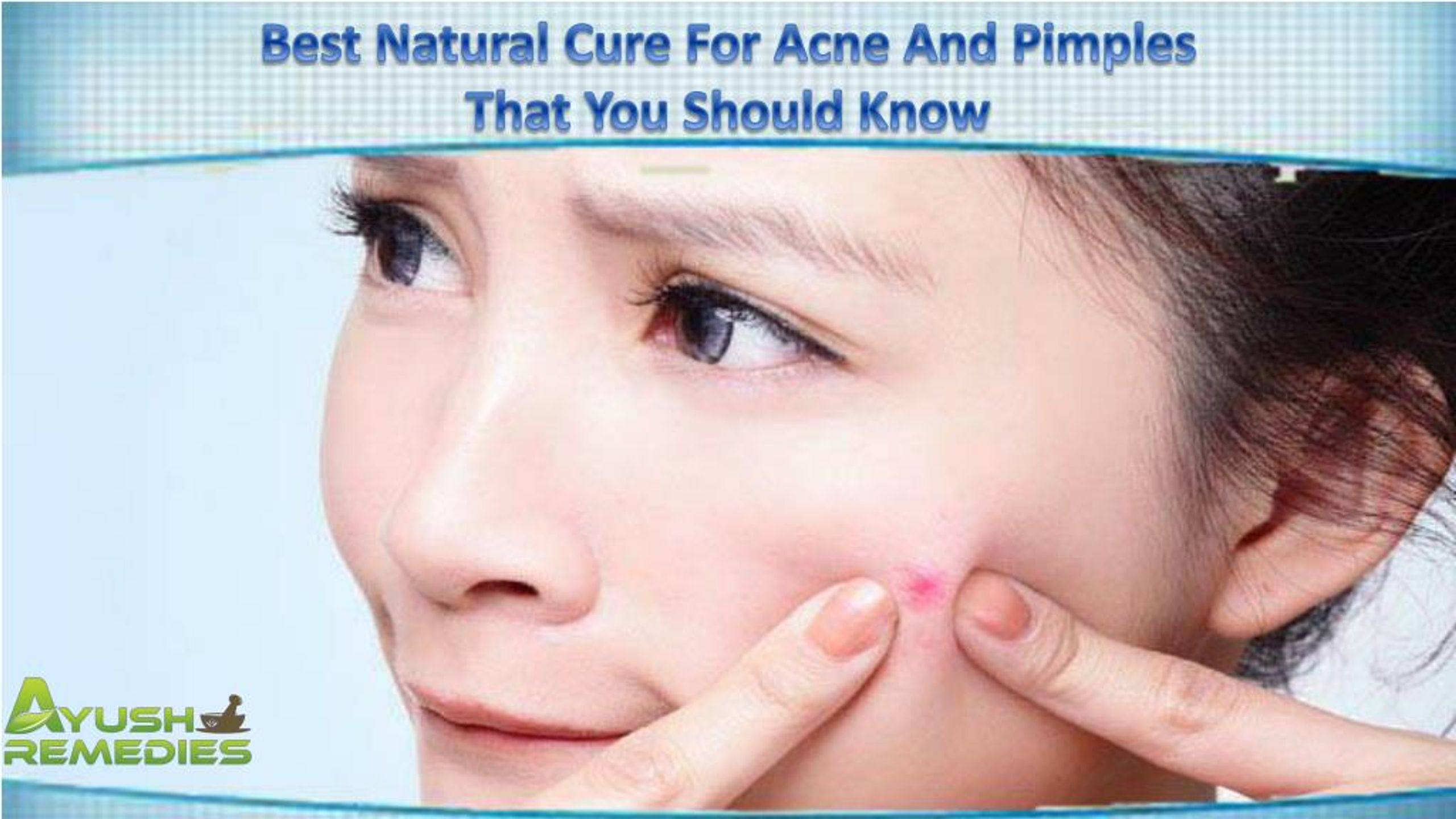 PPT Best Natural Cure For Acne And Pimples That You Should Know