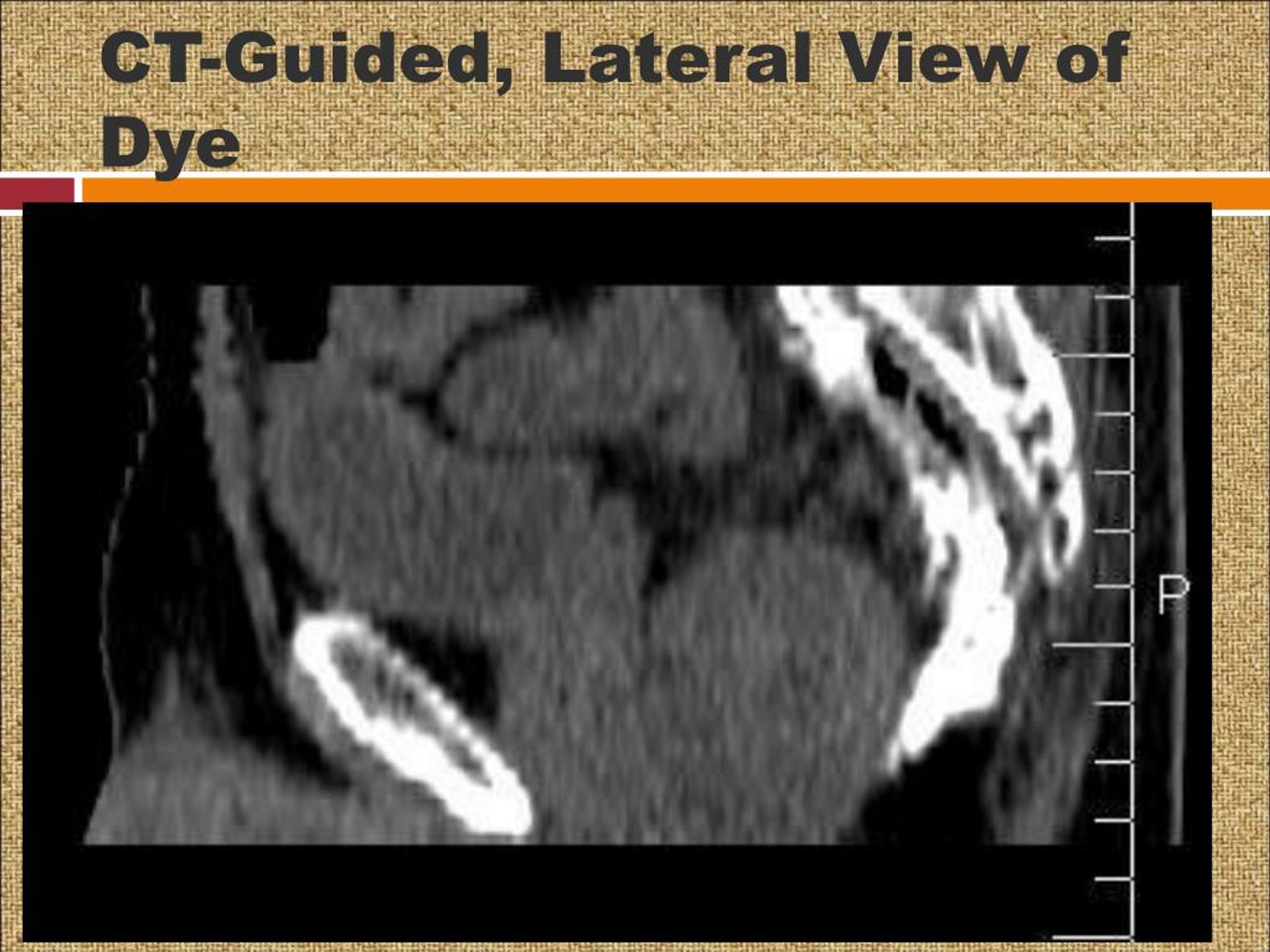 PPT Ganglion Impar Block PowerPoint Presentation, free download ID7376893