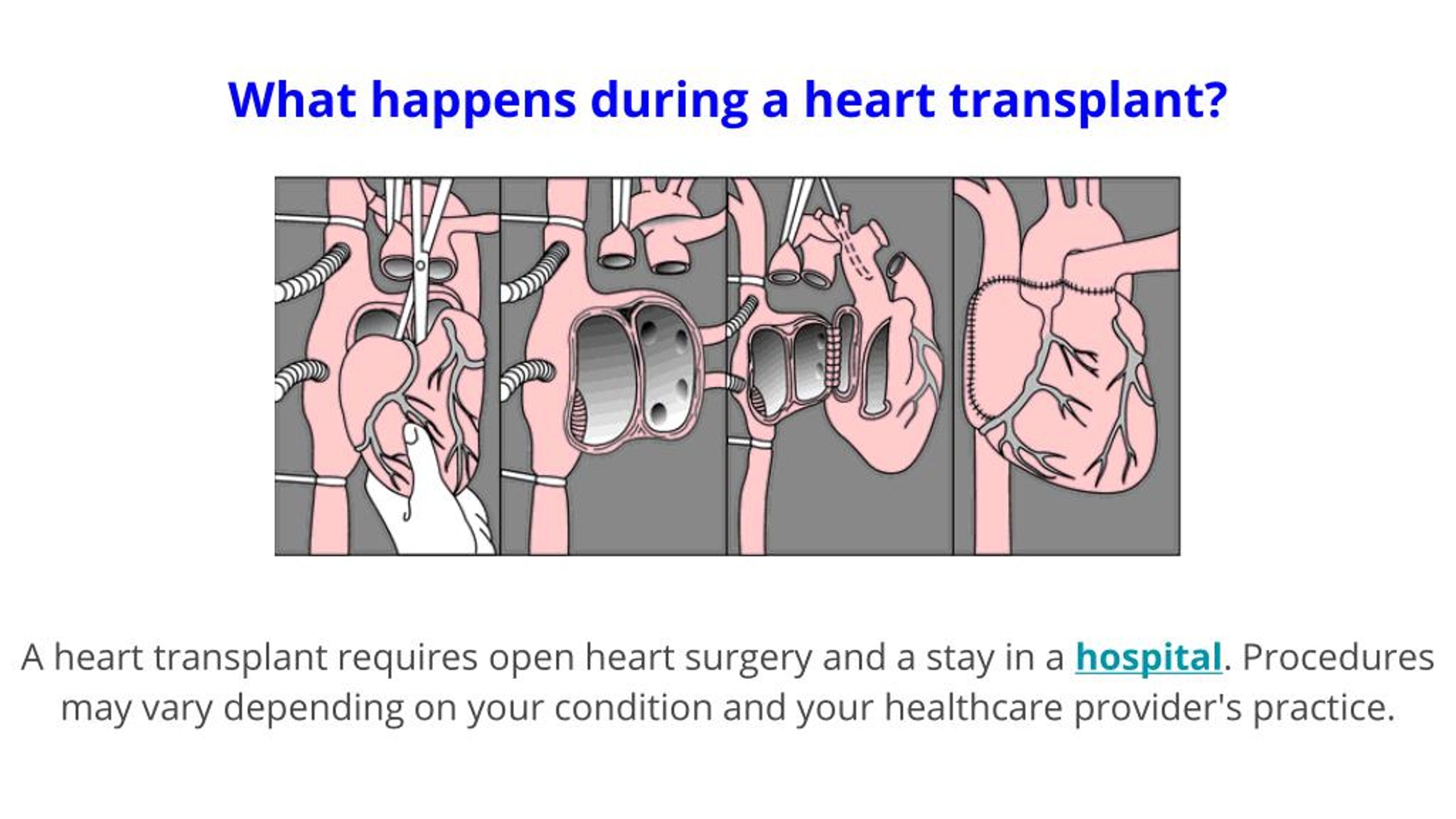 PPT Know More About Heart Transplantation PowerPoint Presentation