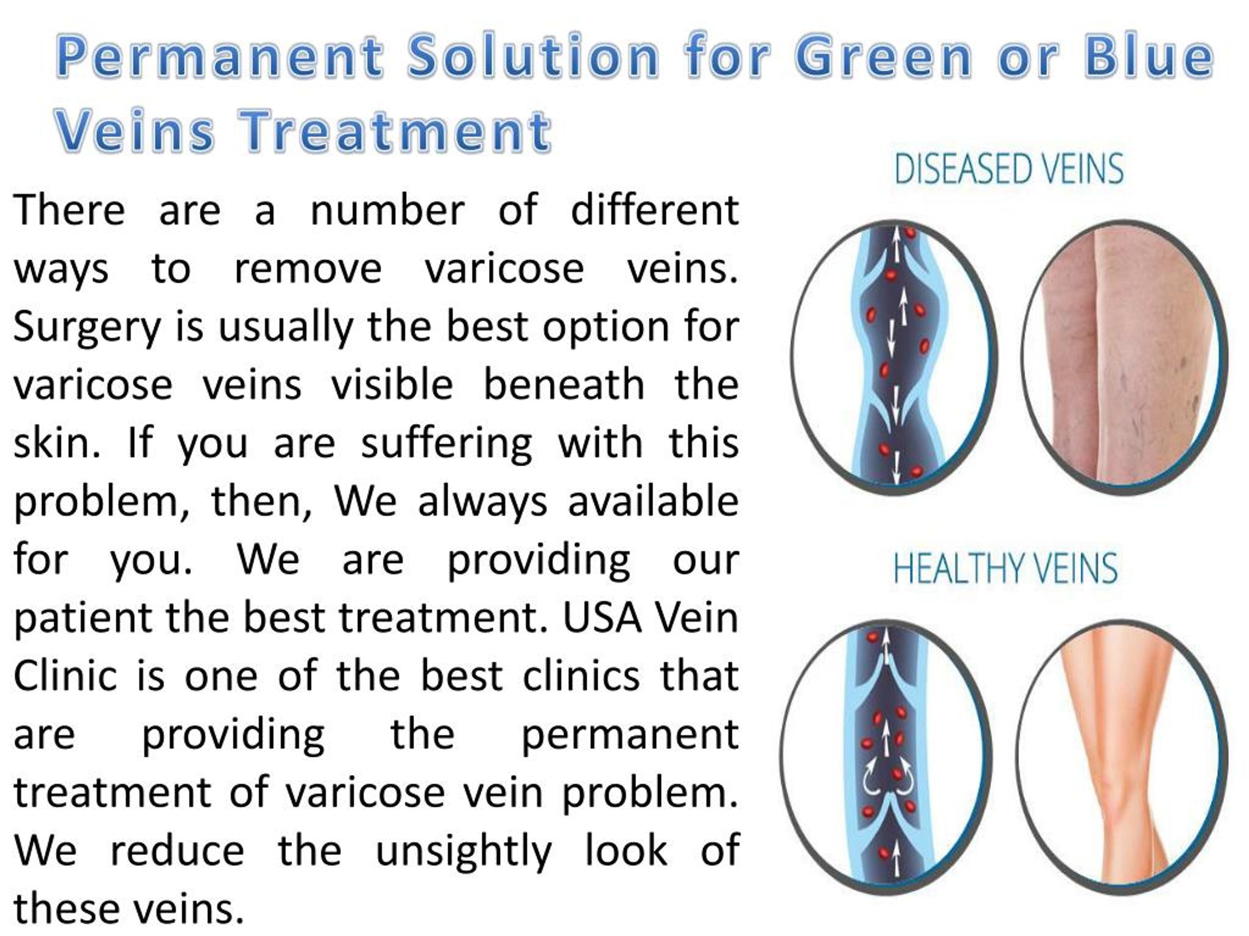 PPT varicose vein removal cost PowerPoint Presentation, free download