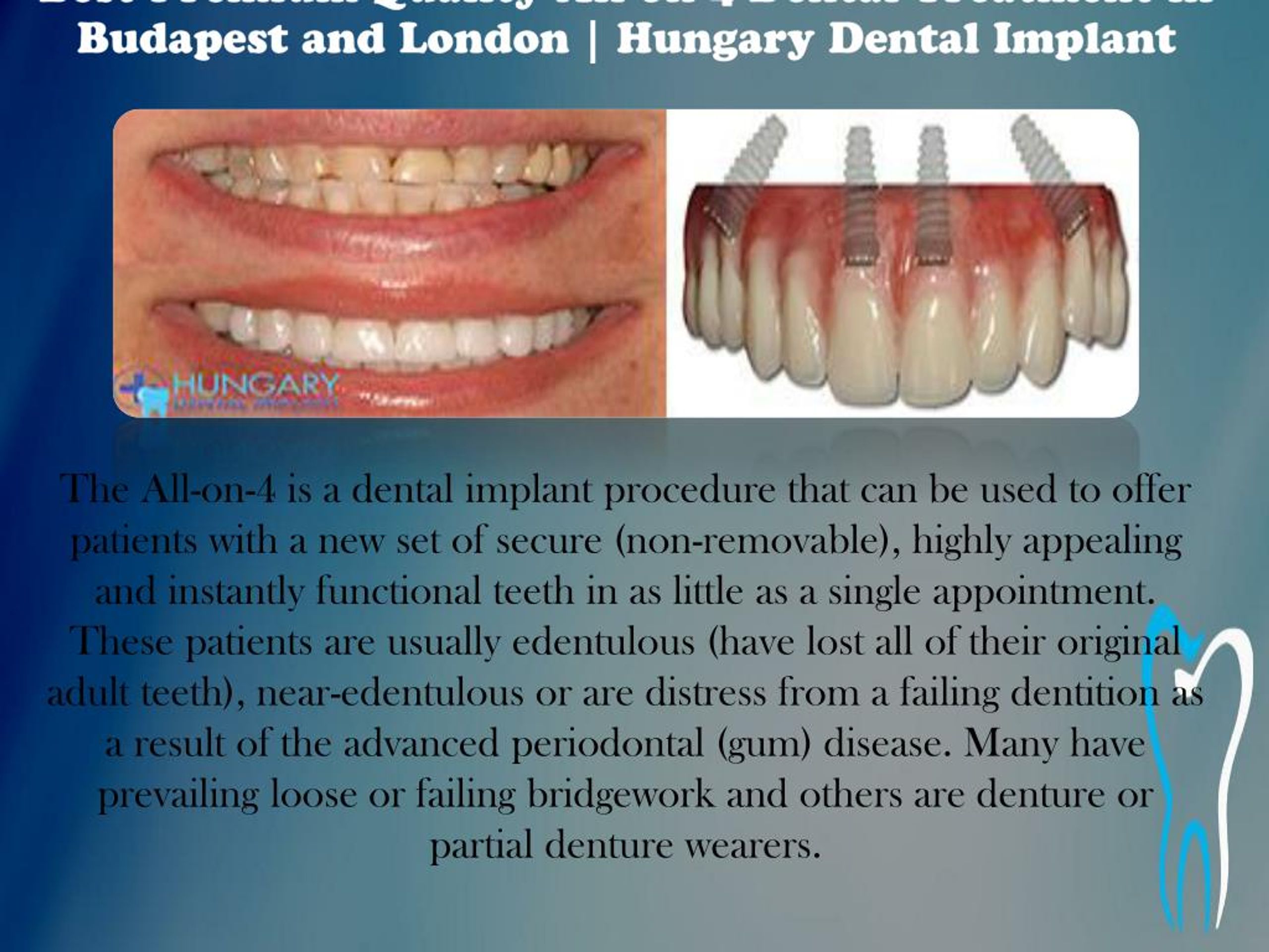 PPT Premium All on 4 Dental Implant Budapest (Hungary) PowerPoint