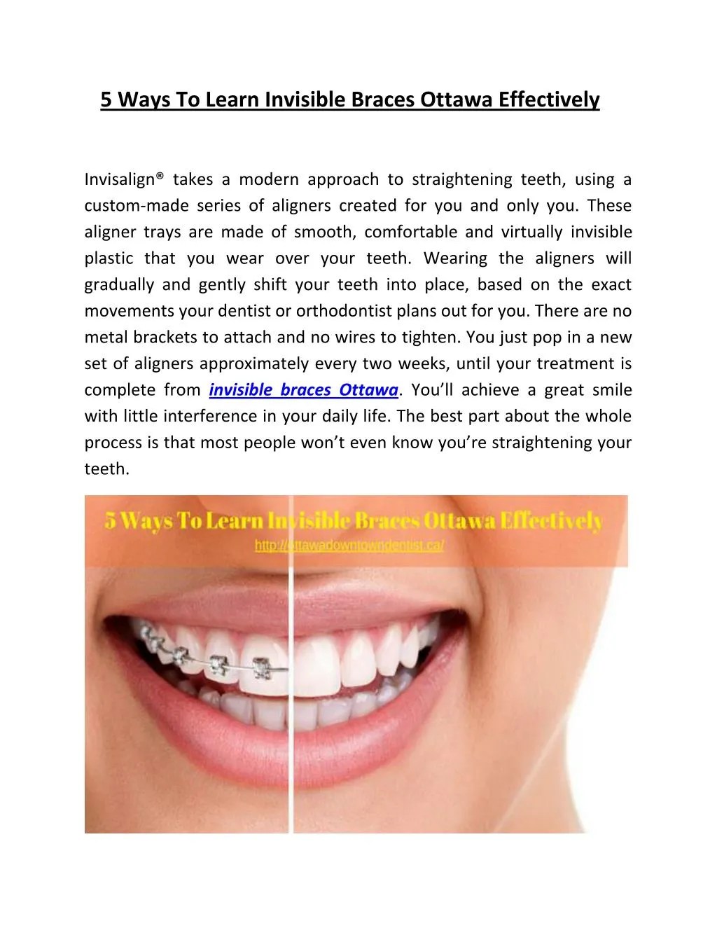 PPT 5 Ways to Learn Invisible Braces Ottawa Effectively PowerPoint