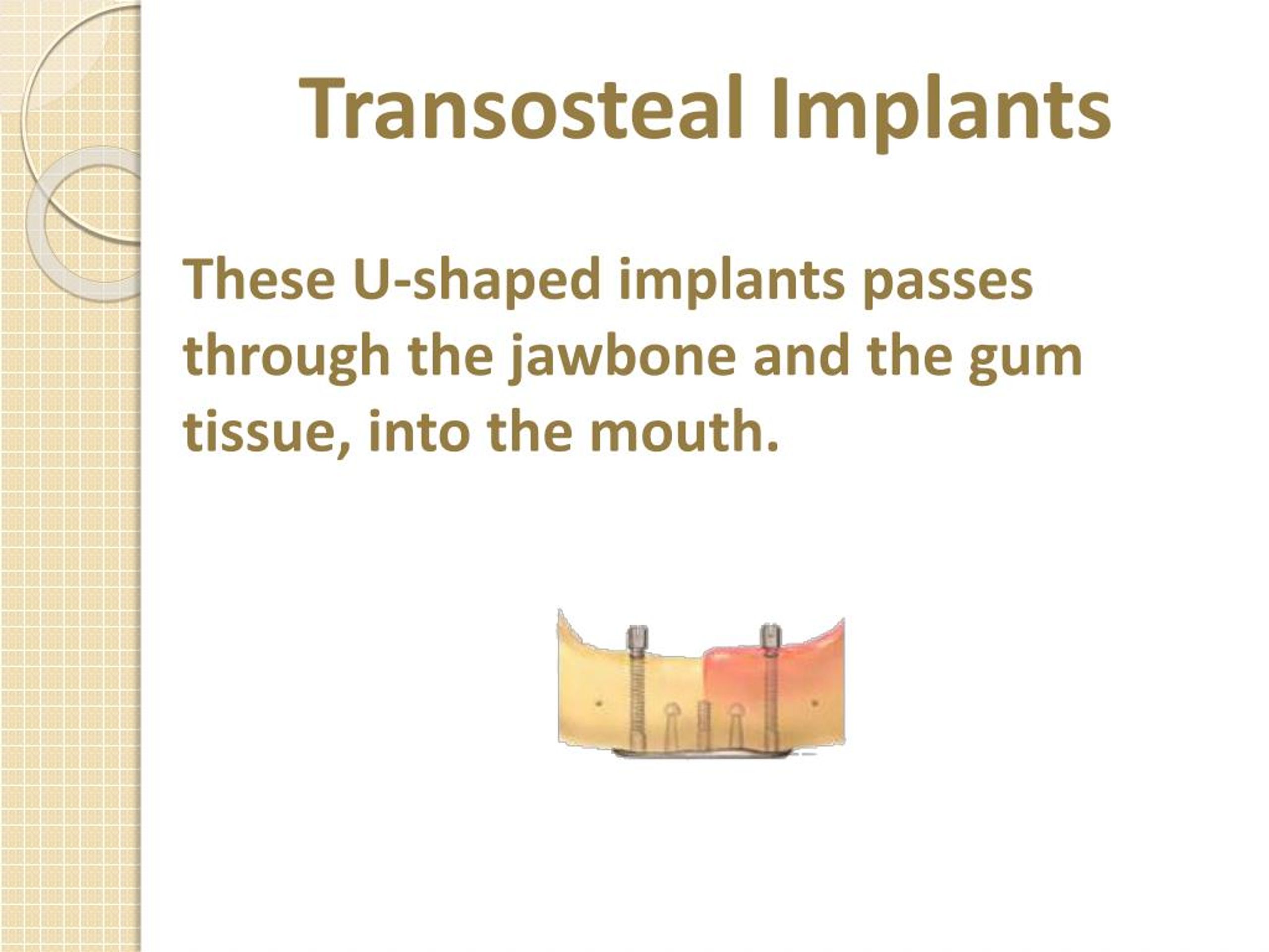 PPT An Overview of Dental Implants PowerPoint Presentation, free
