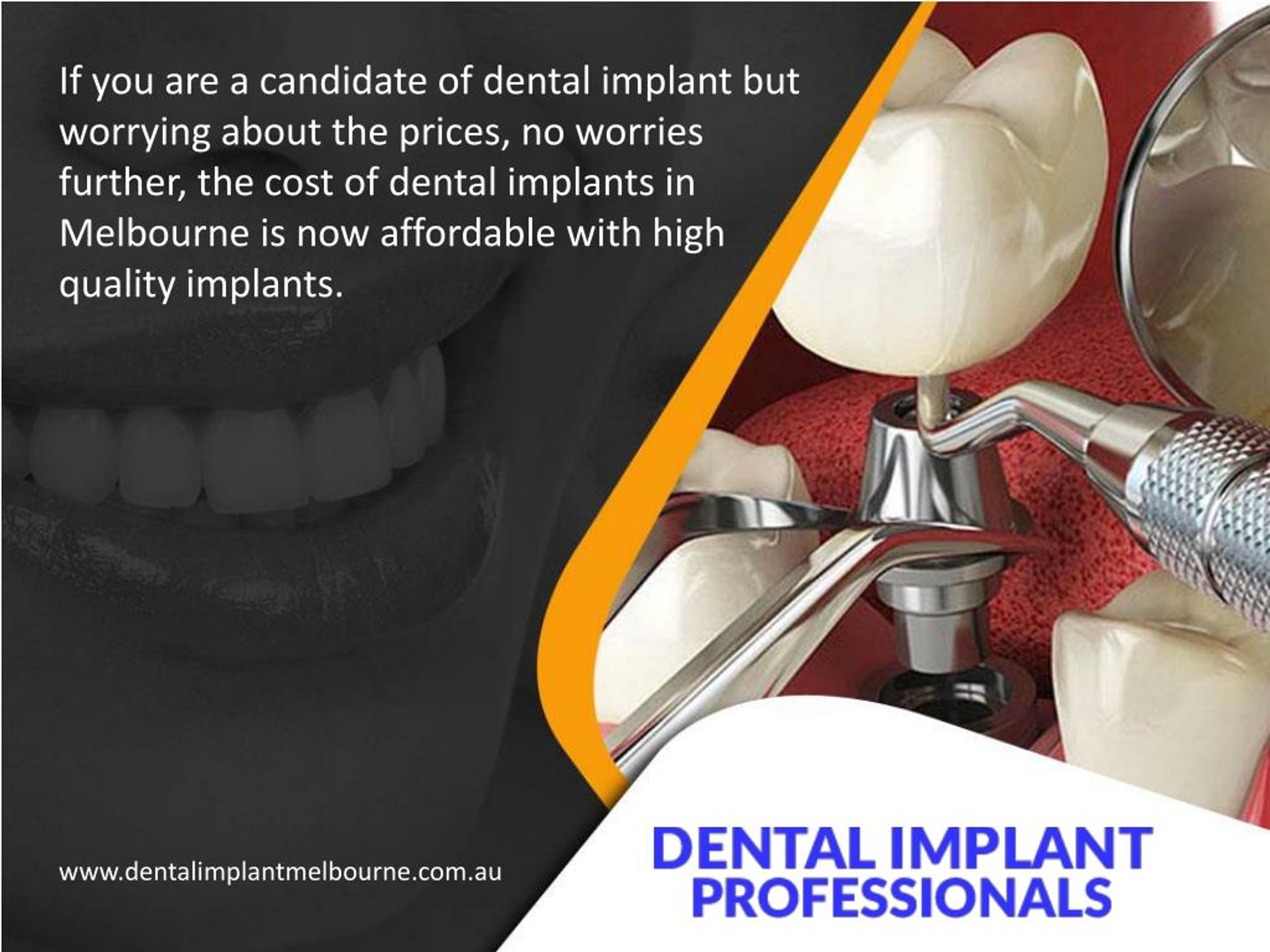 PPT Affordable and High Quality Dental Implants in Melbourne