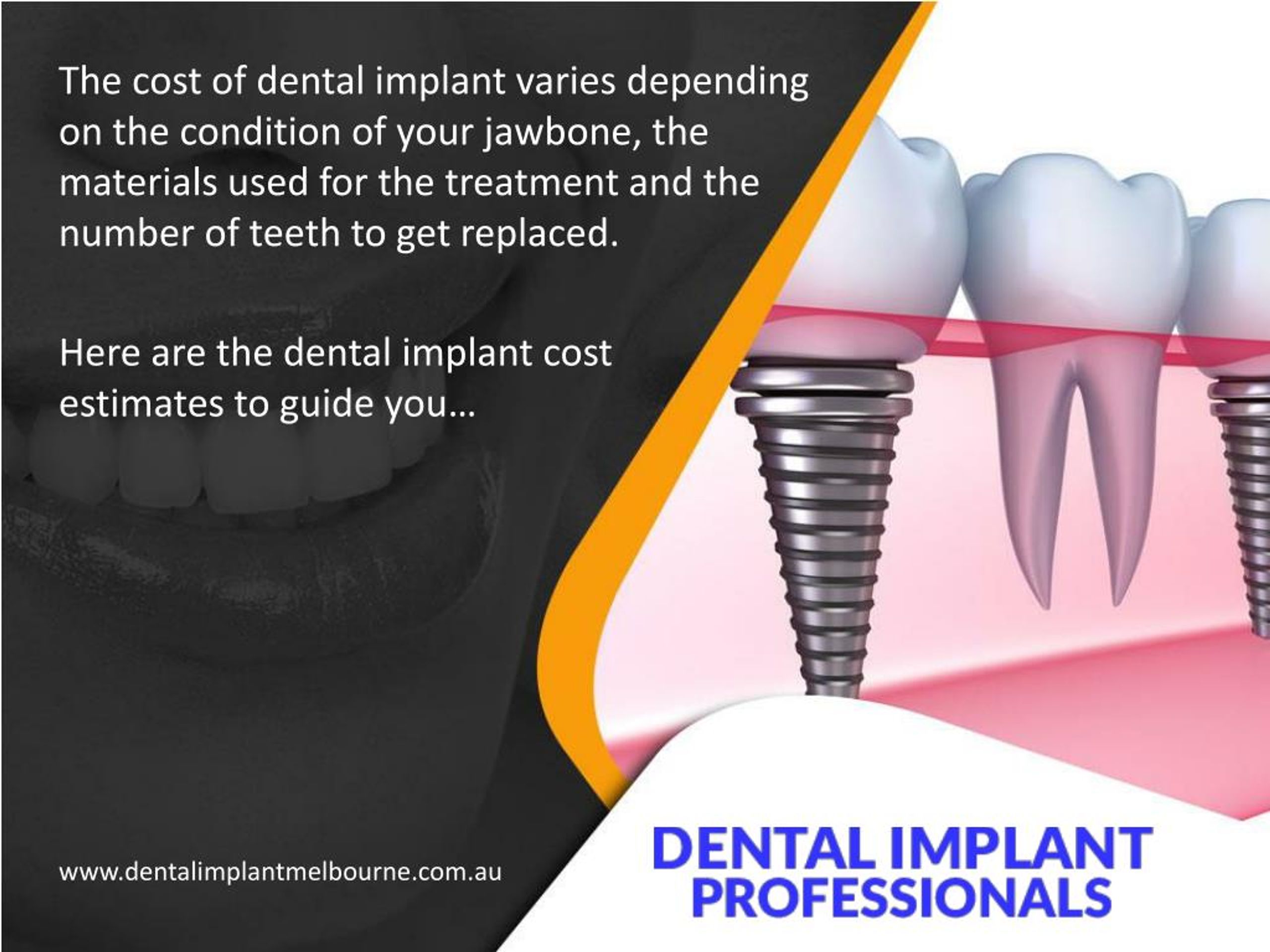 PPT Affordable and High Quality Dental Implants in Melbourne