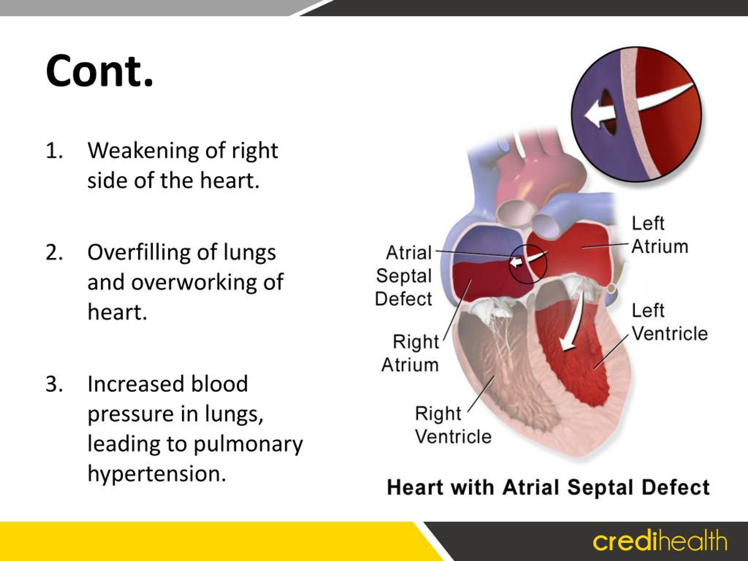 PPT Atrial Septal Defect / Hole in Heart Things You Should Know PowerPoint Presentation ID