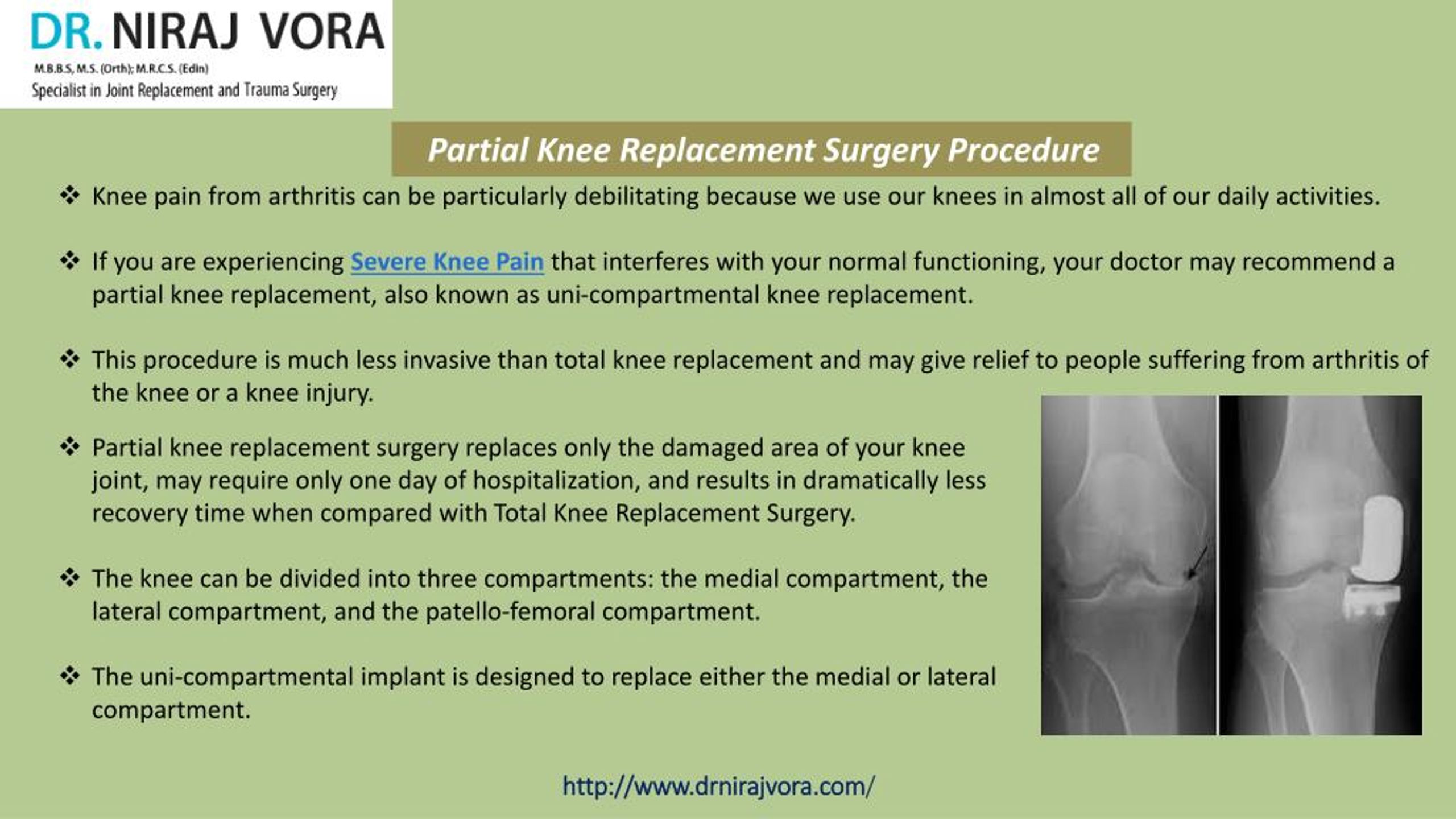 Partial Knee Replacement Procedure