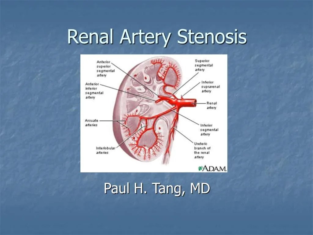 PPT Renal Artery Stenosis PowerPoint Presentation, free download ID
