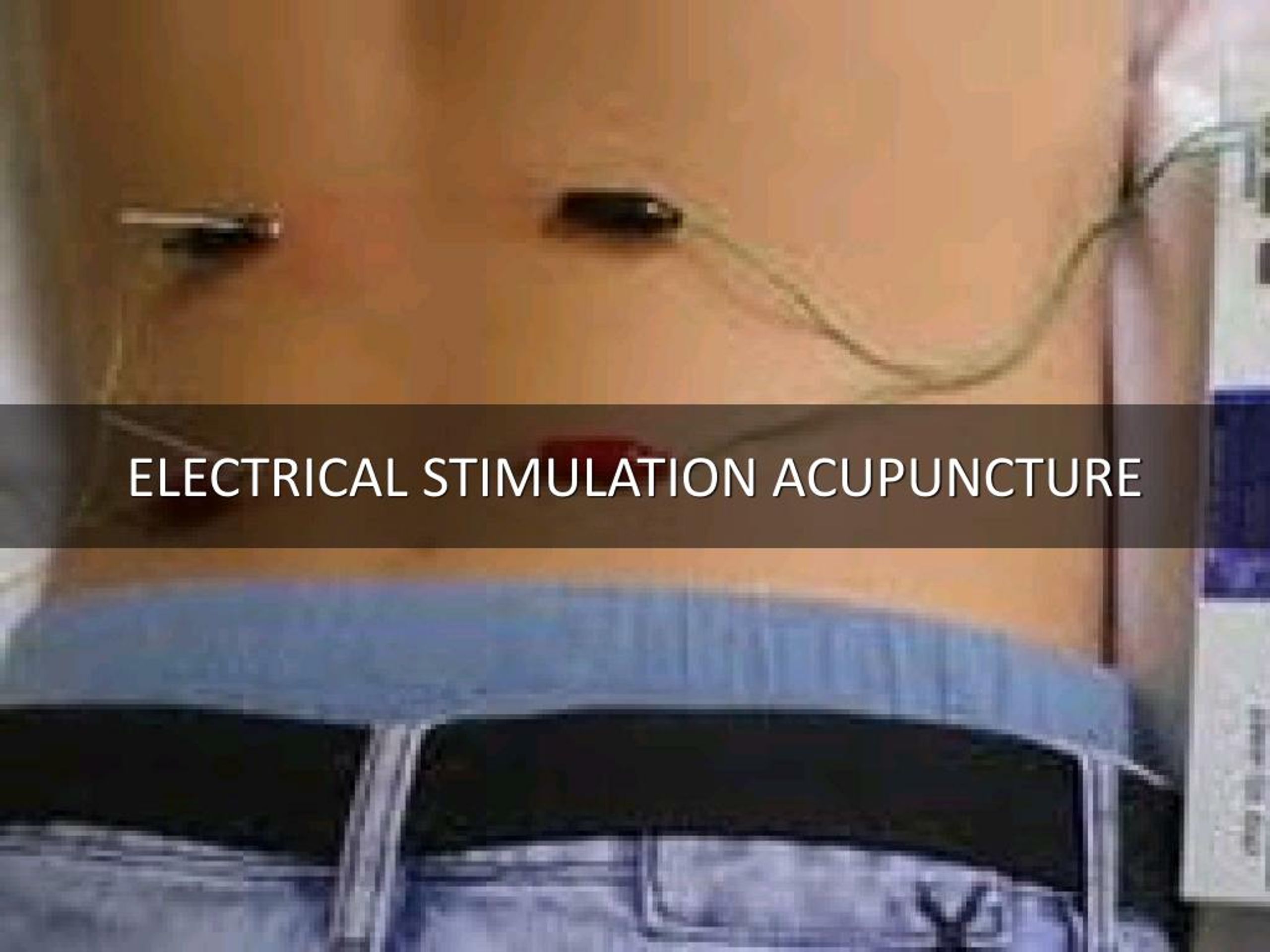 PPT Detail Presentation About Sunshine State Acupuncture PowerPoint Presentation ID7727334