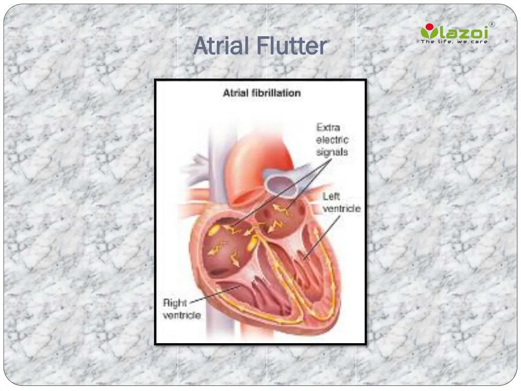 PPT Atrial Flutter PowerPoint Presentation, free download ID7927247