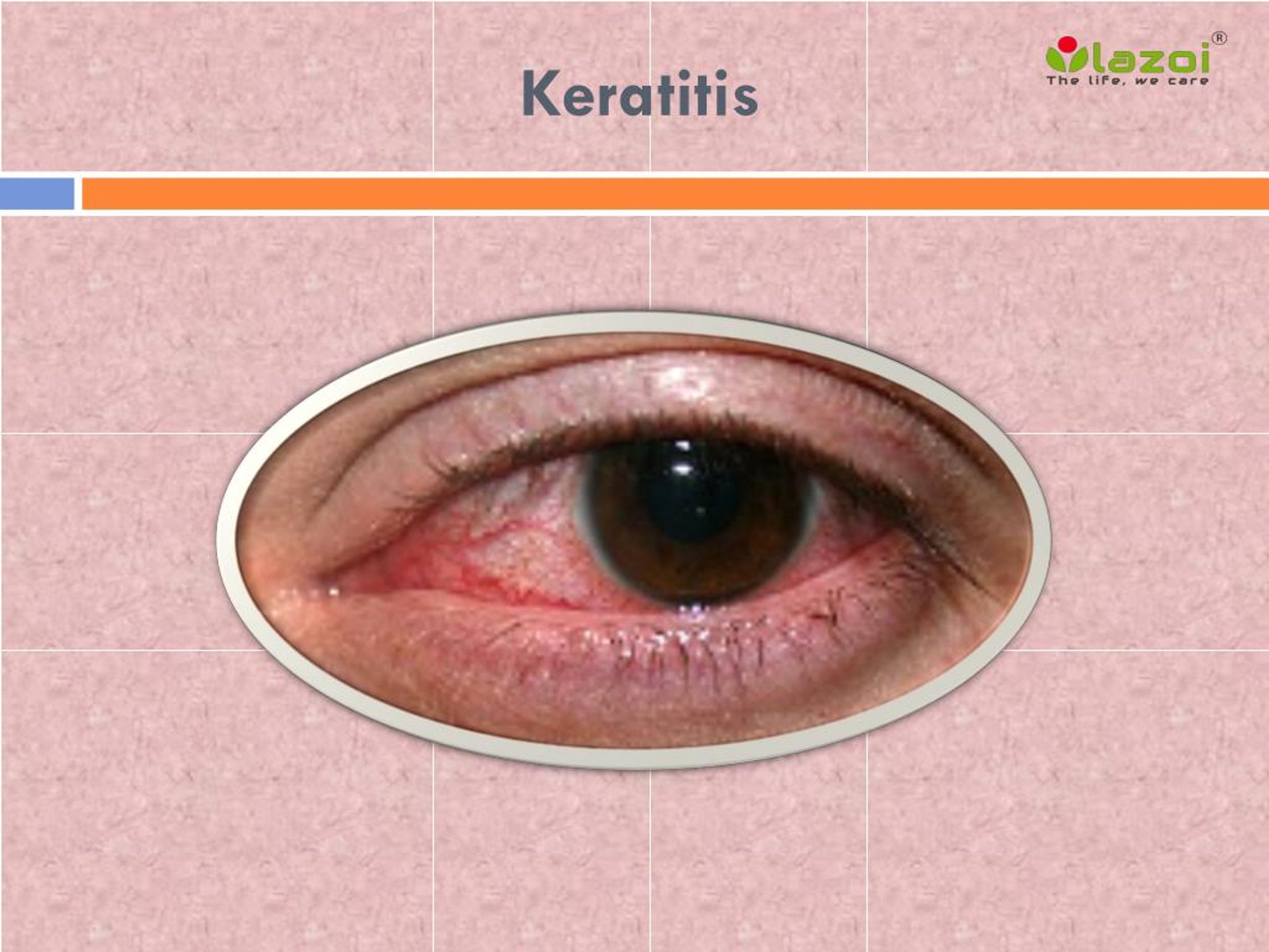 PPT Keratitis Causes, Symptoms, Daignosis, Prevention and Treatment