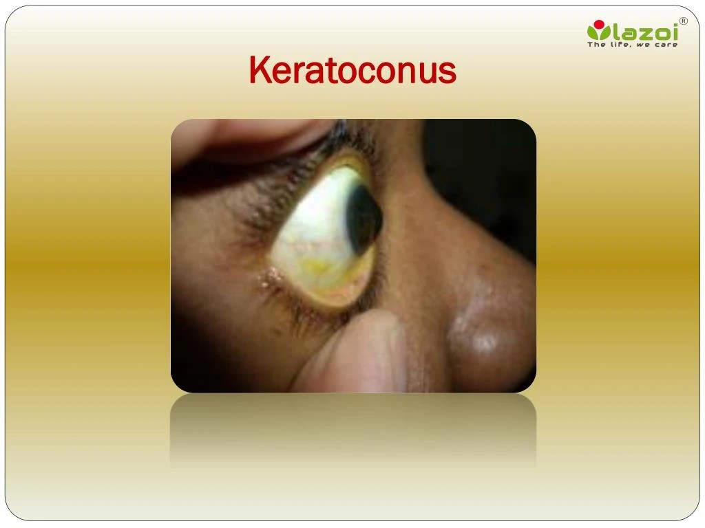 PPT Keratoconus Causes, Symptoms, Daignosis, Prevention and