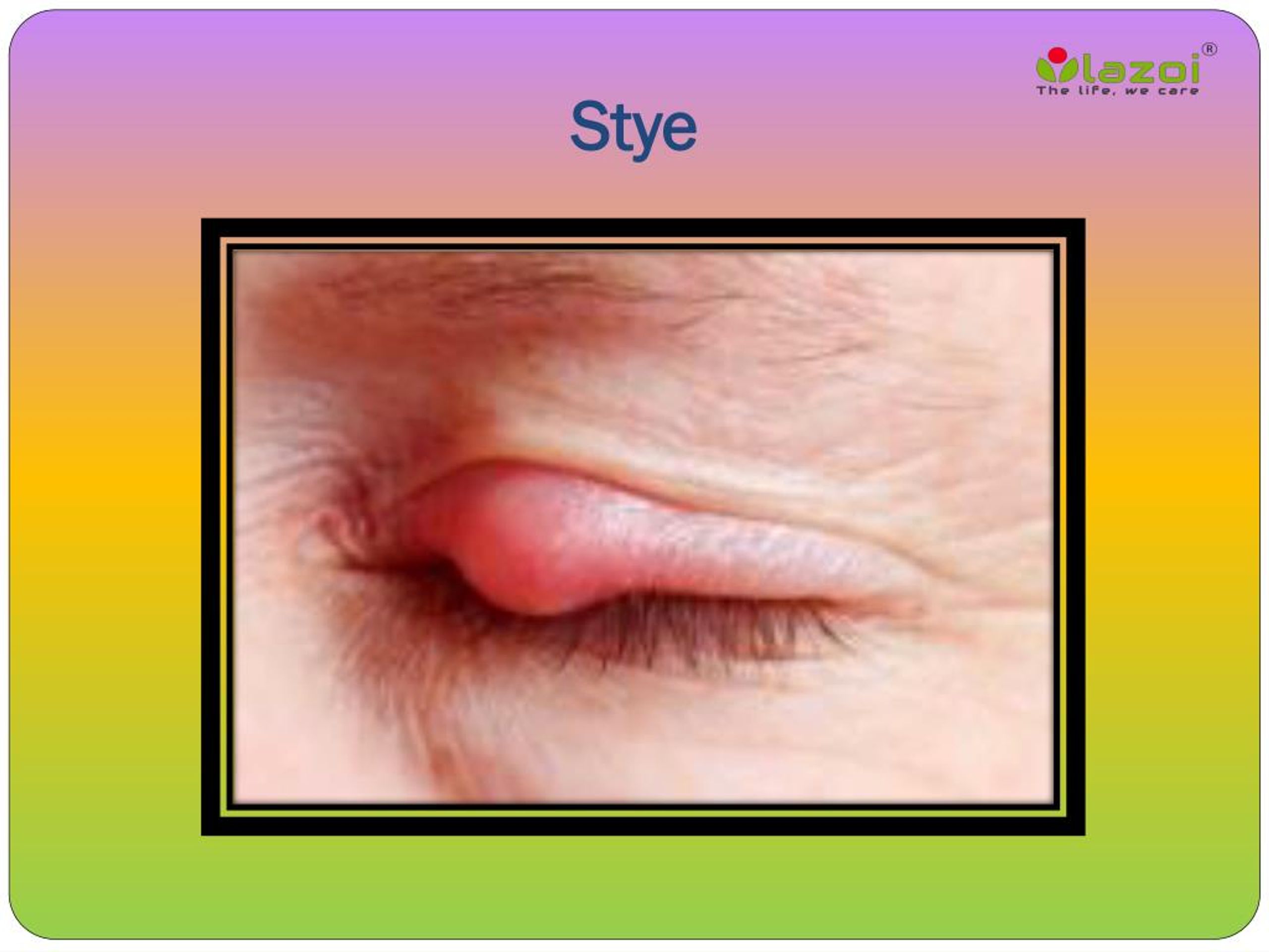 PPT Stye Causes, Symptoms, Daignosis, Prevention and Treatment