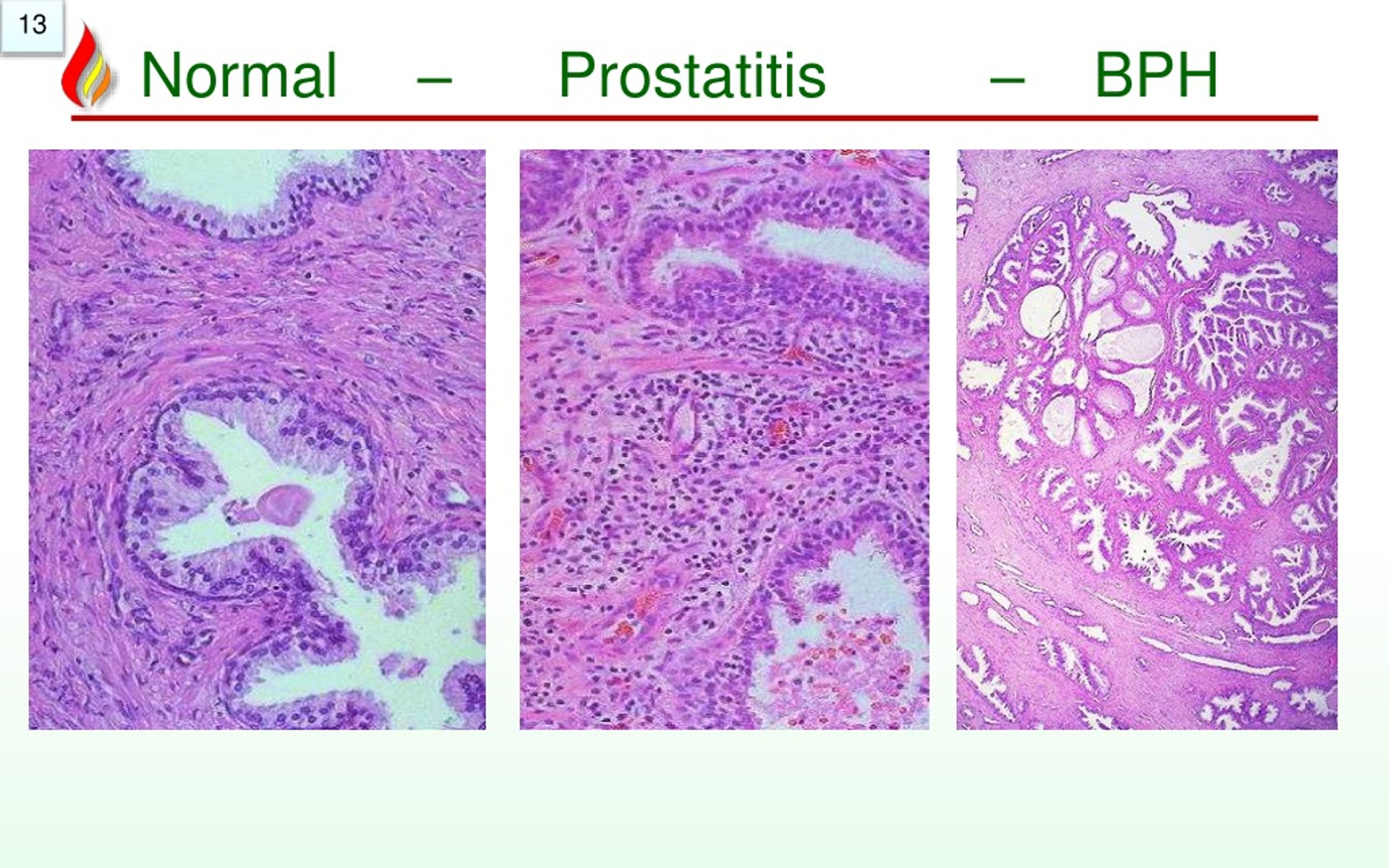 PPT Pathology of Prostate Benign PowerPoint Presentation, free