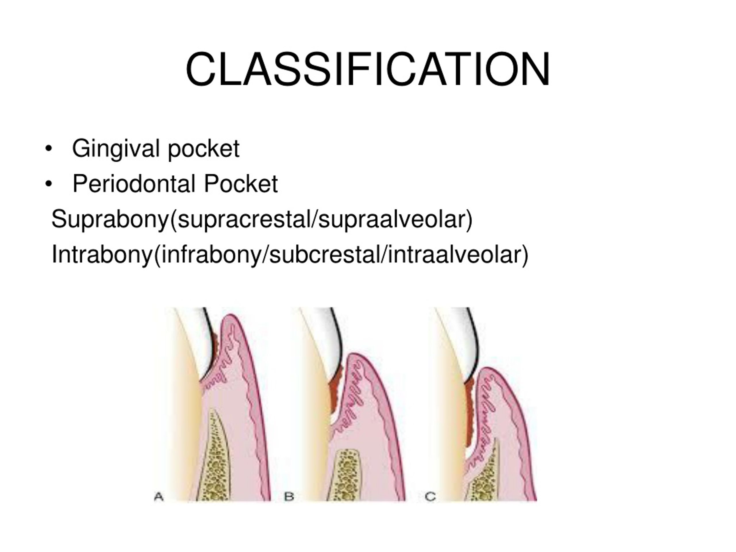 PPT PERIODONTAL POCKET PowerPoint Presentation, free download ID