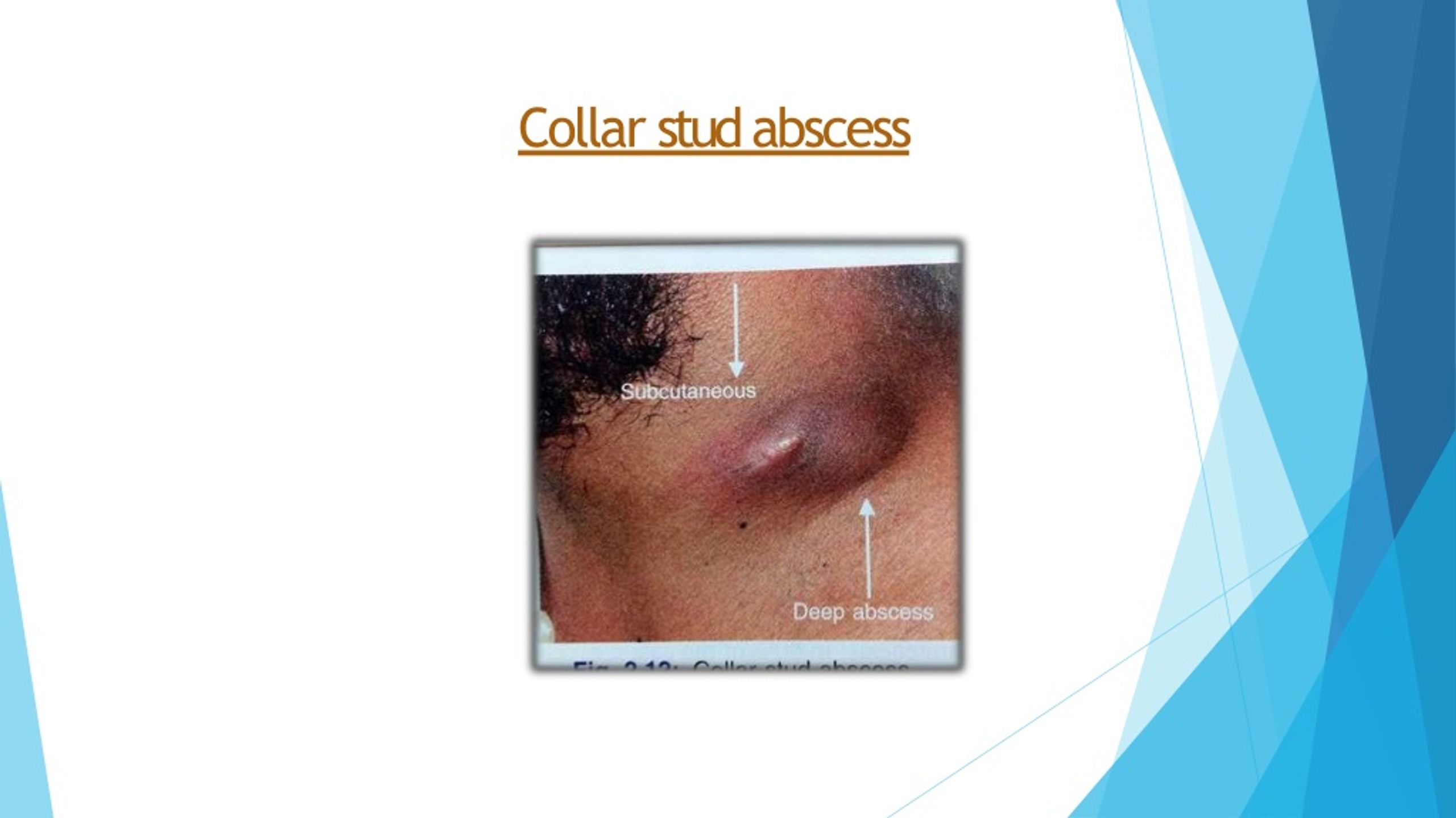 PPT SINUS AND FISTULA PowerPoint Presentation, free download ID8980358