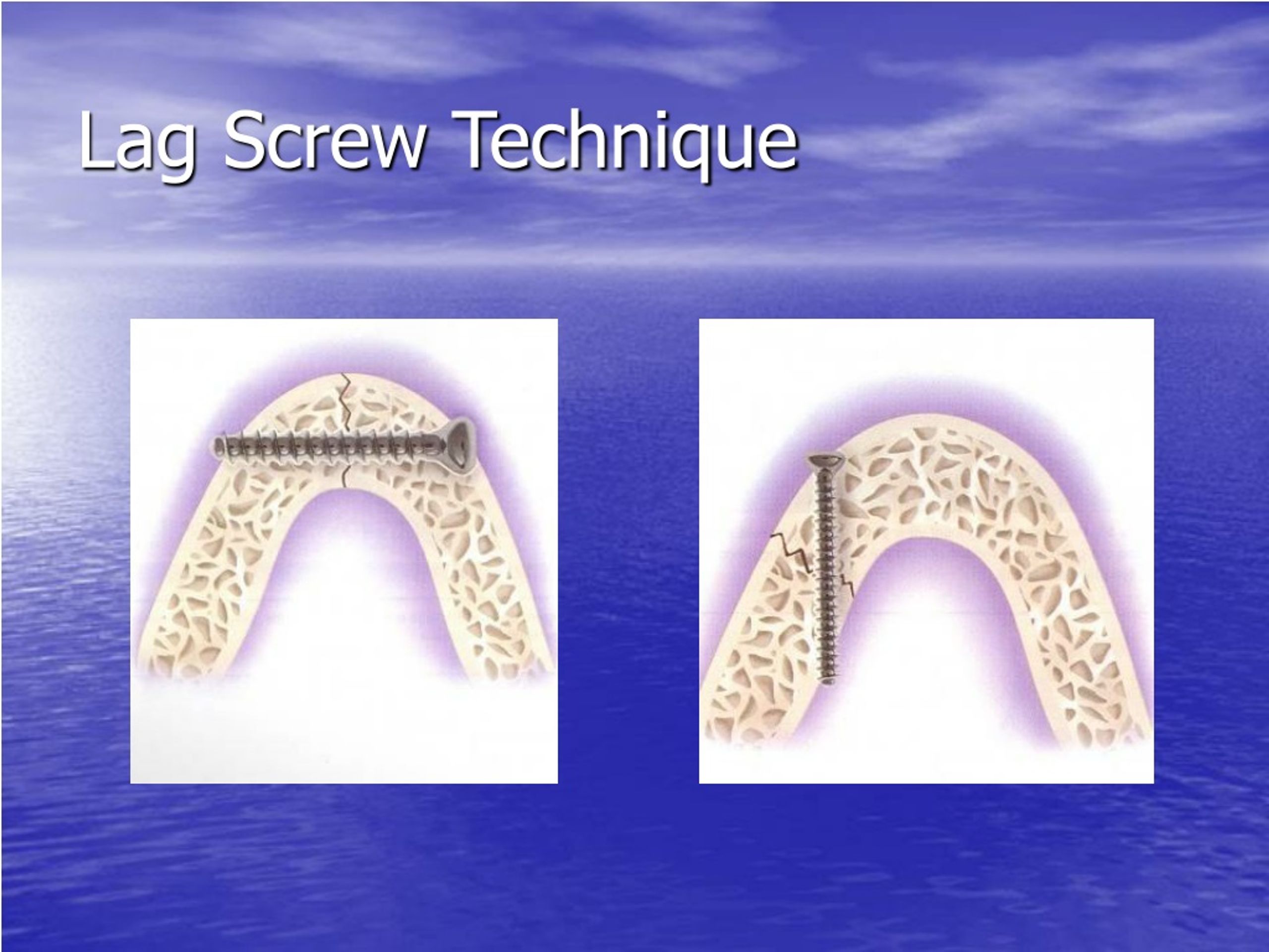 PPT Mandible Fractures PowerPoint Presentation, free download ID9245708