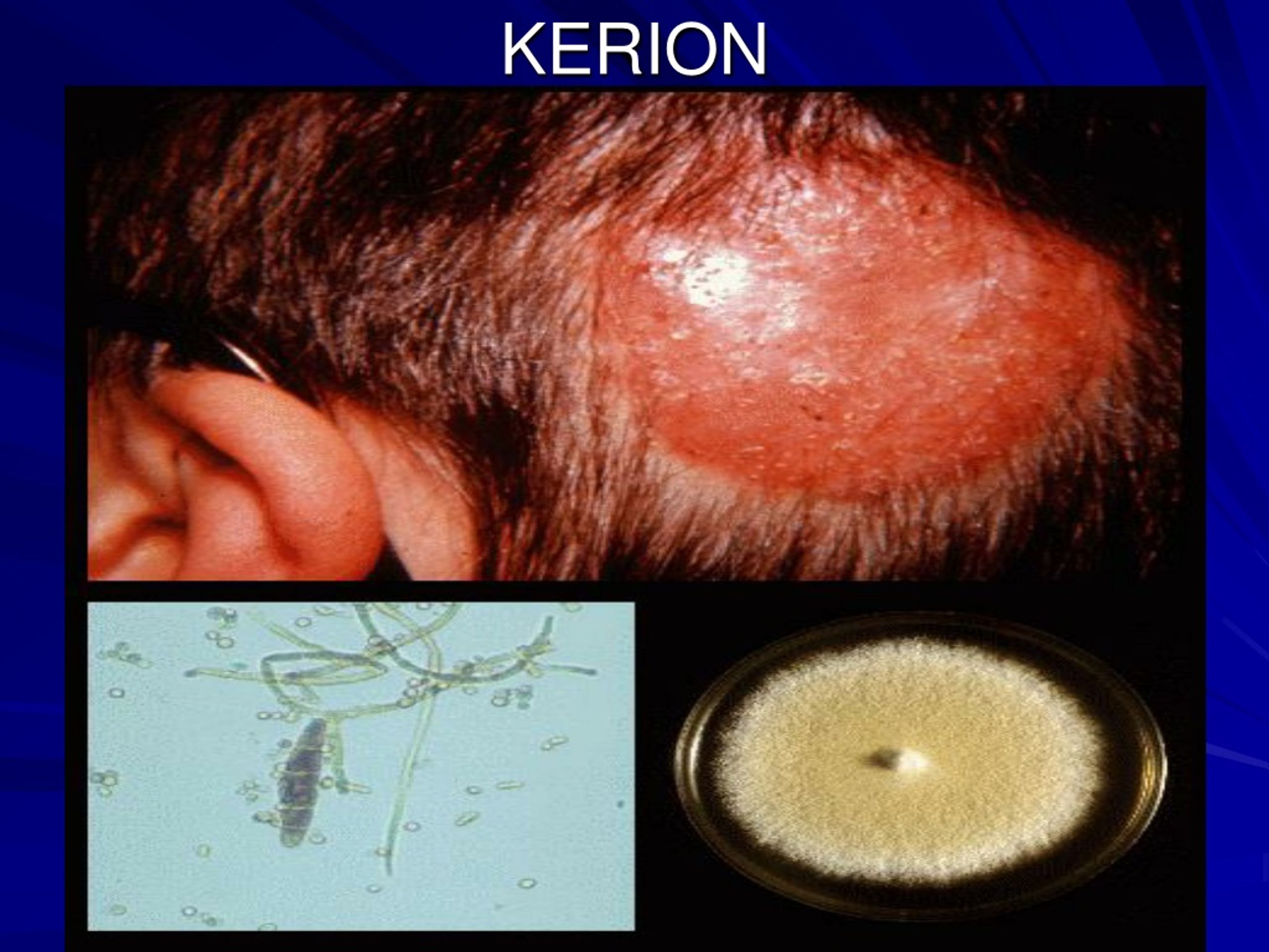 PPT Dermatomycoses from head to toe PowerPoint Presentation, free