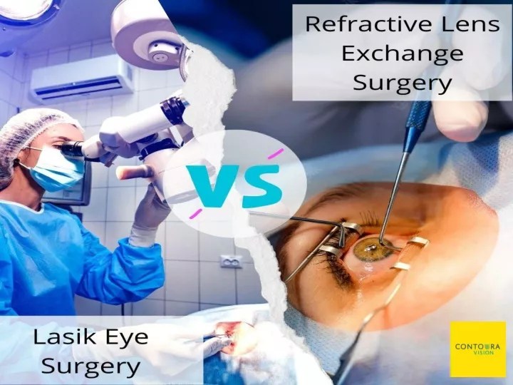 PPT Lasik vs RLE eye surgery PowerPoint Presentation, free download