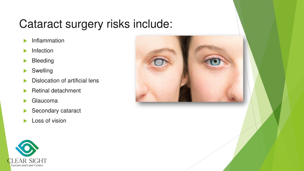 PPT Cataract Surgery_Dr. Sonia Maheshwari PowerPoint Presentation