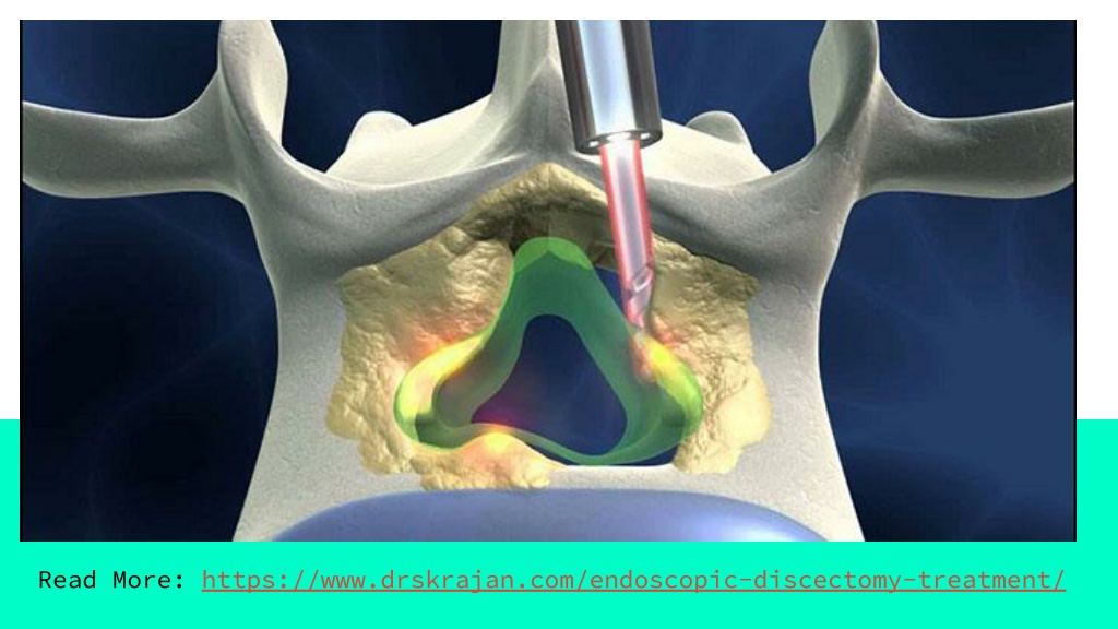 PPT Endoscopic Discectomy Surgeon in Gurgaon PowerPoint Presentation