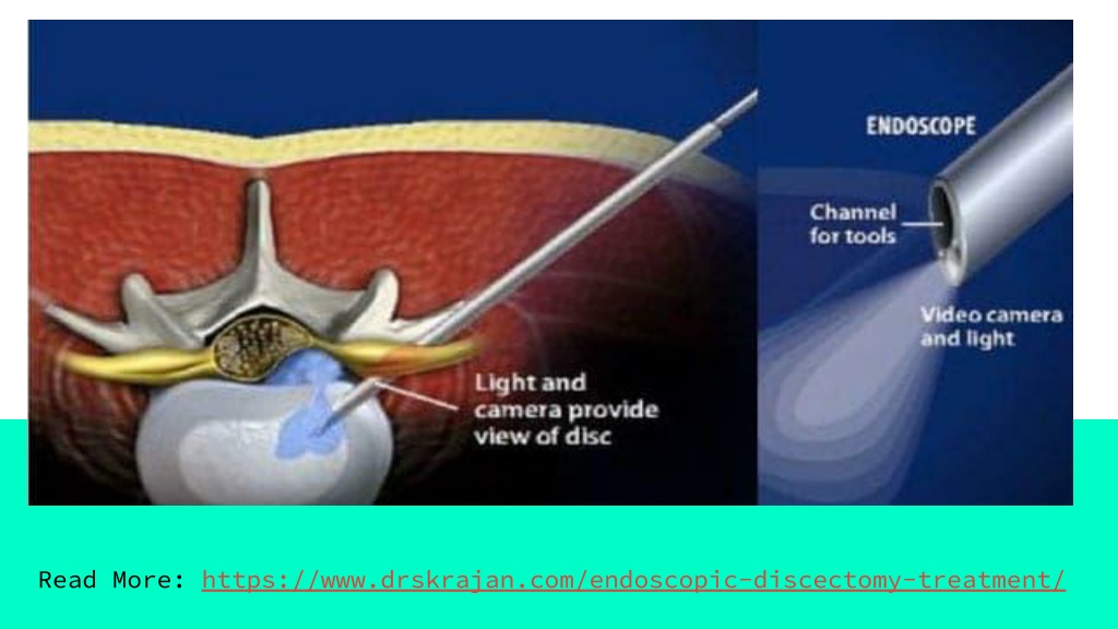 PPT Endoscopic Discectomy Surgeon in Gurgaon PowerPoint Presentation
