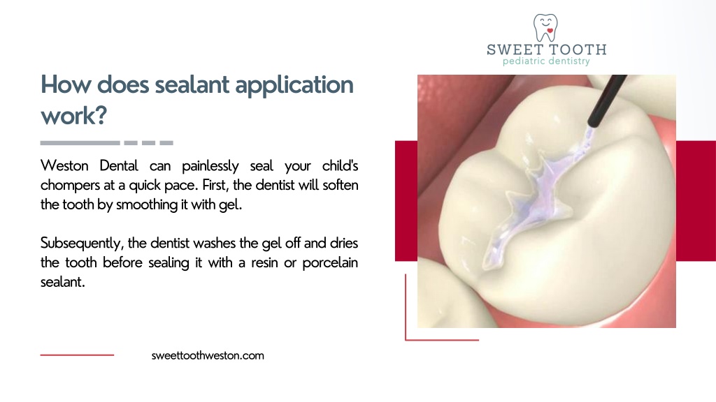 PPT Preventing Tooth Decay in Children The Role of Dental Sealants PowerPoint Presentation
