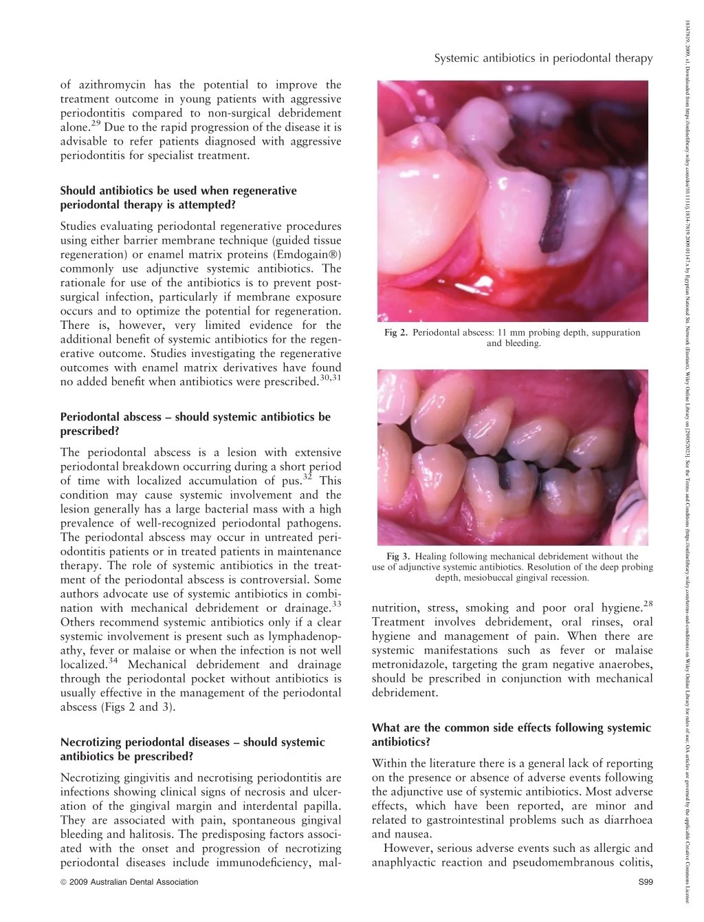 PPT Systemic antibiotics in periodontal therapyامراض اللثة د حاتم