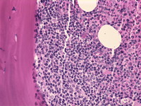 Follicular lymphomabone marrow biopsy 3.