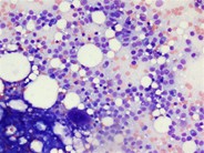 Hairy cell leukemia 1.