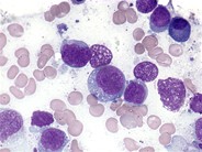Extranodal NK/Tcell lymphoma 4.