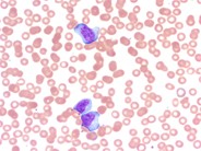Reactive lymphocytes 1.