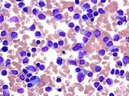 Chronic Lymphocytic Leukemia Thrombocytopenia 8.