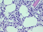 Bone Marrow Biopsy in Hairy Cell Leukemia The fried egg