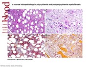 Bone marrow histopathology in polycythemia and postpolycythemia