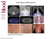 Classic findings of POEMS syndromes