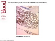 Bone marrow biopsy in HCL stained with antiCD20 monoclonal antibody