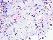Gaucher's Disease 6.