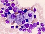 Gaucher's Disease 1(b).