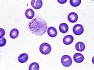 Hairy Cell Leukemia 11.