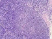 Mantle Cell Lymphoma 1.