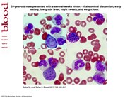 A myeloproliferative neoplasm with translocation t(8;9)(p22;p24