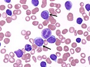 Chronic Lymphocytic Leukemia 2.