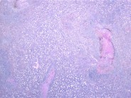 Autoimmune Lymphoproliferative Syndrome 1.