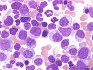 Pathology Outlines Atypical chronic myeloid leukemia (aCML)