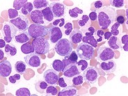 Pathology Outlines Atypical chronic myeloid leukemia (aCML)